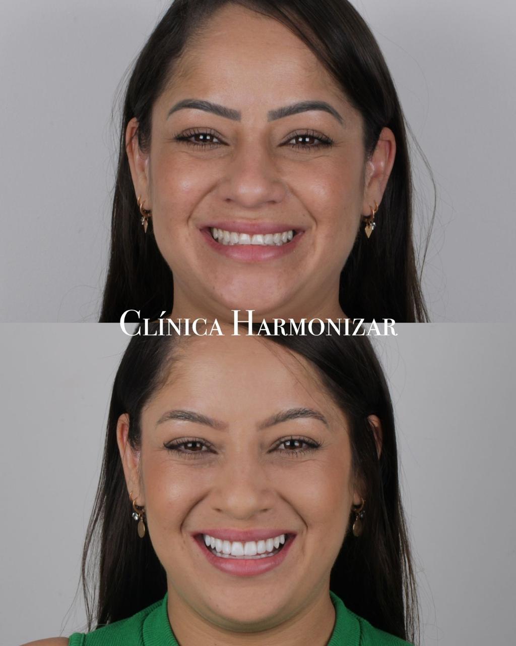 Antes e depois 2