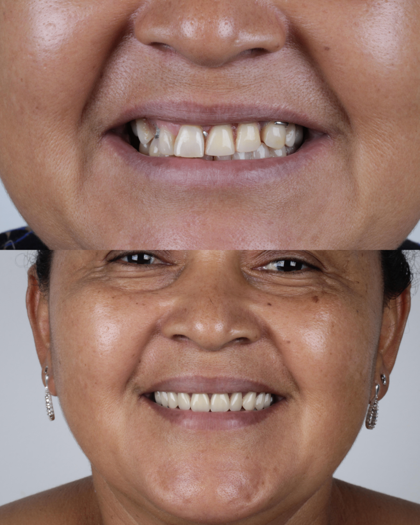 Antes e depois 5