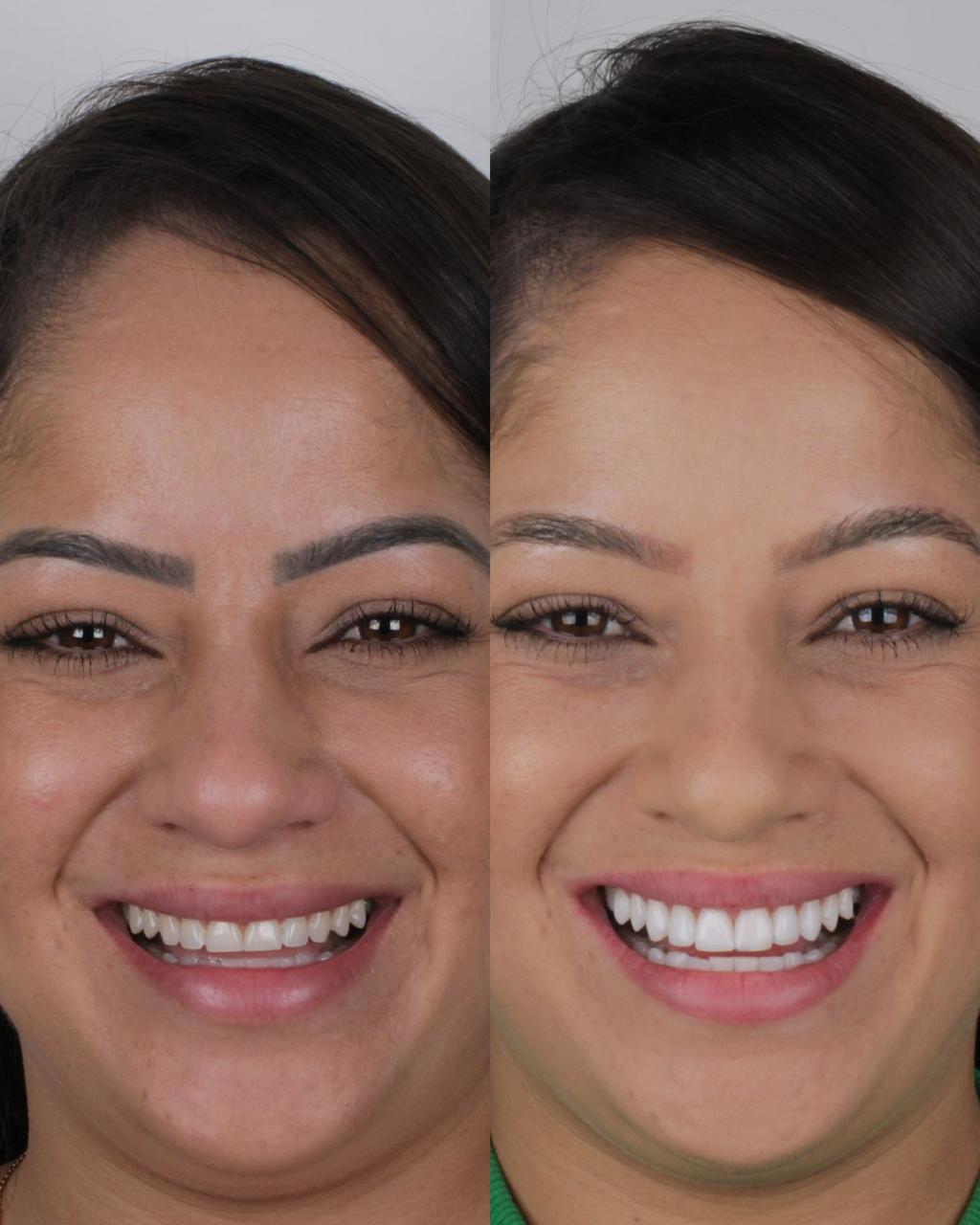 Antes e depois 1