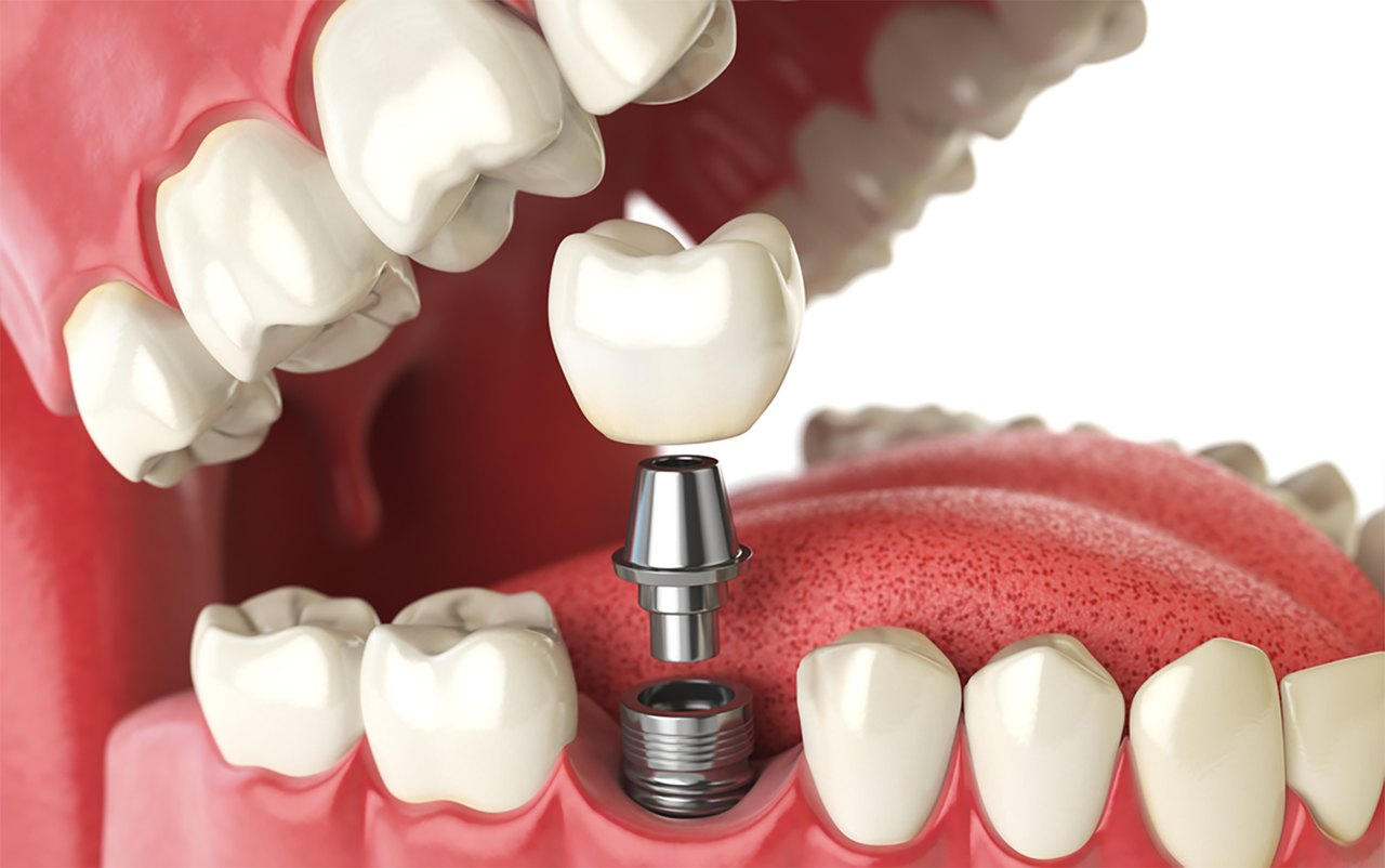 Implantes dentários