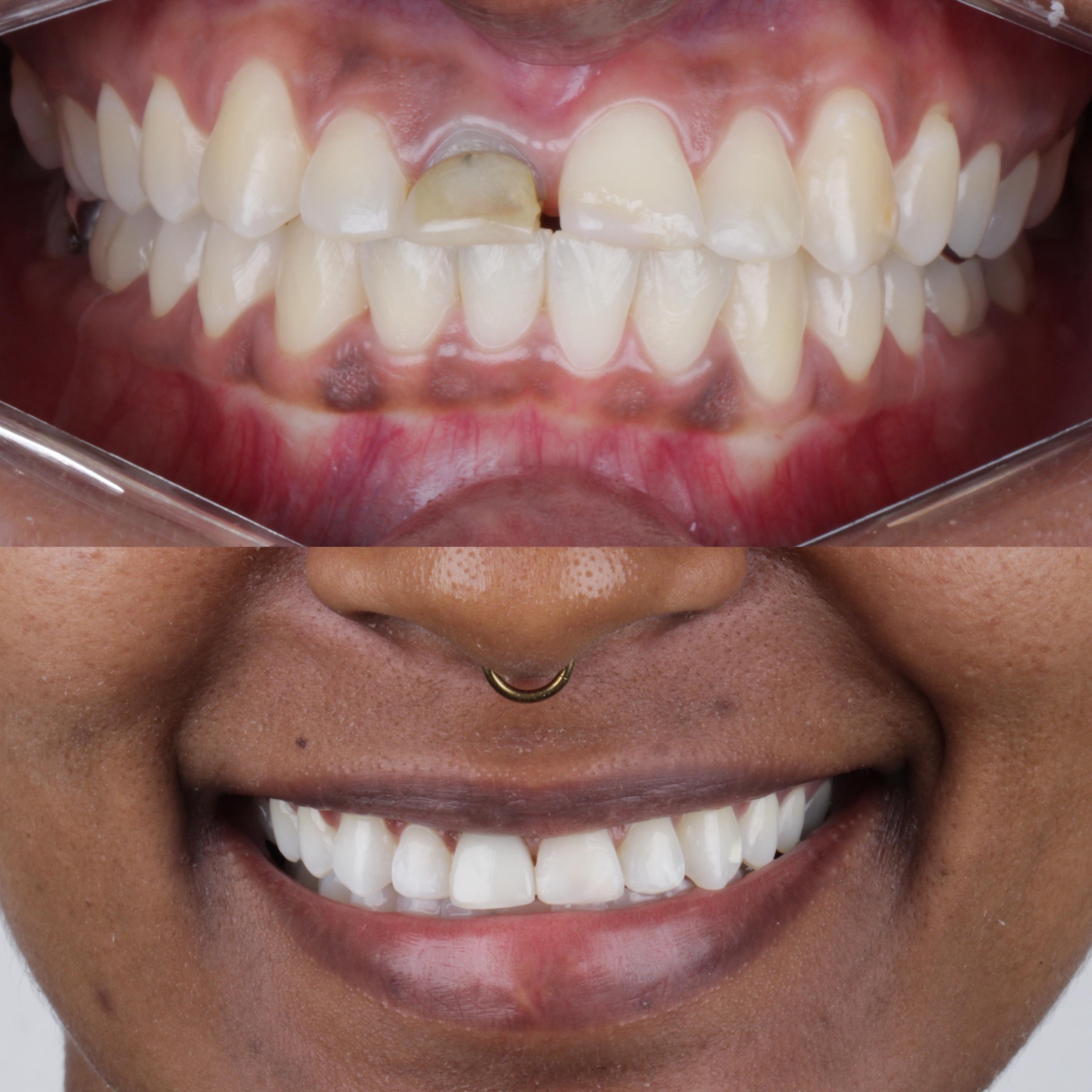 Antes e depois 4